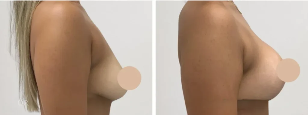 breast lift in dubai