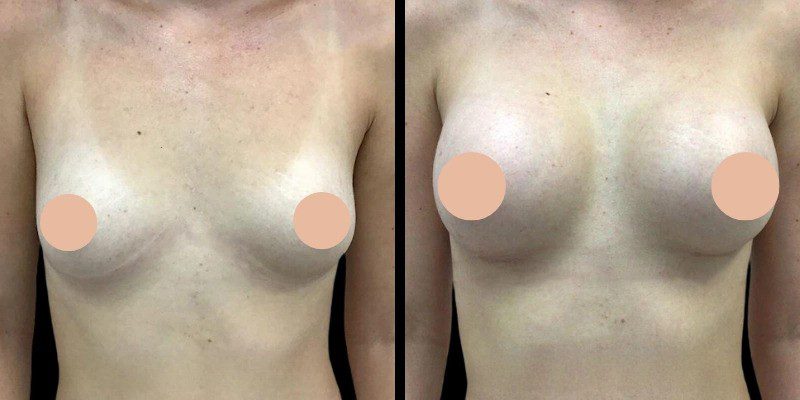 Are You a Good Candidate for Breast Augmentation in Dubai? Here’s What to Know