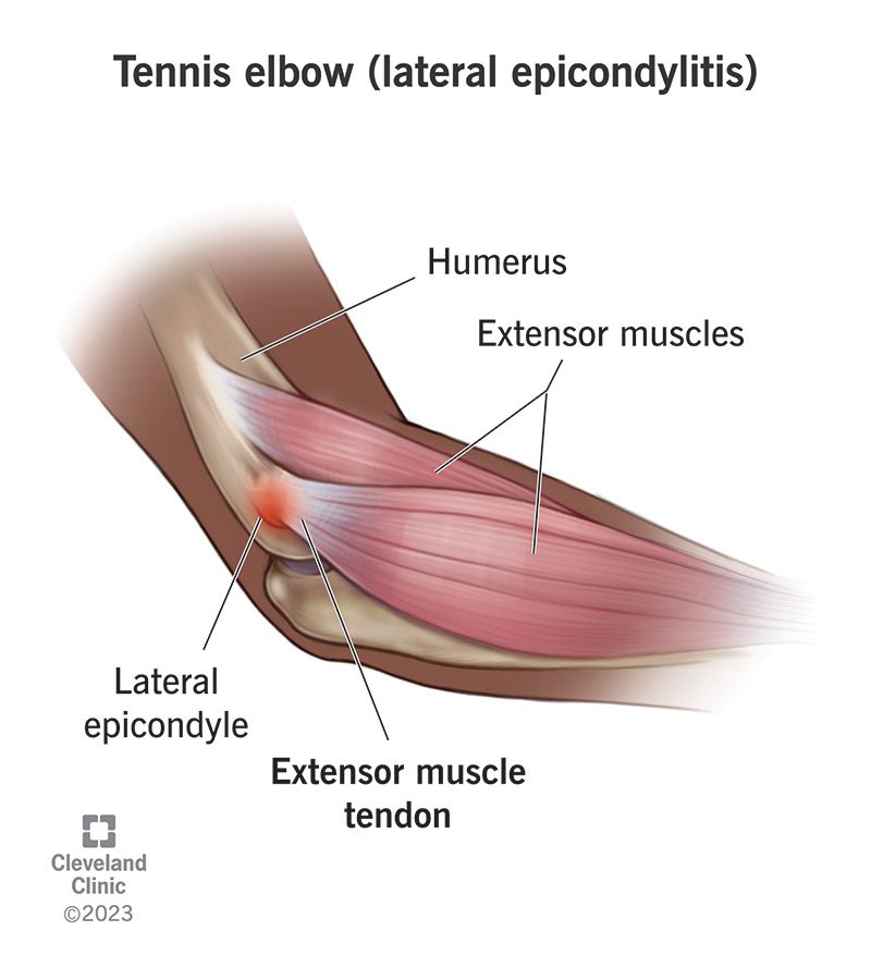 Muscle tennis elbow pain. Try Pain O Soma 500 to treat your pain.